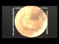 Removal Of Earwax Plug From A Child S External Auditory Canal Following Softening 20260519