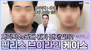 [유.케.리] 📍 CT로 보는 케이스 리뷰 l 전체적으로 넓은 얼굴 l 남자 윤곽 수술 l 사각턱 축소 l