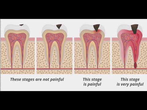 Stages of Tooth Decay: Introduction
