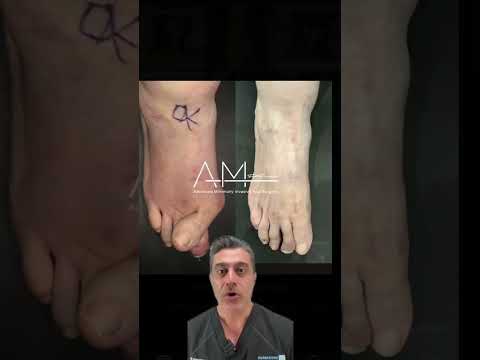 Celebrities with foot condition - Beau Garret