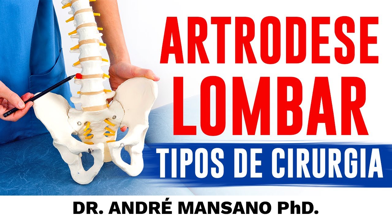 Tipos de Cirurgia da Coluna Lombar – Dr. André Mansano Tratamento da Dor
