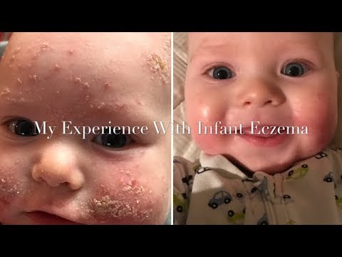 Eczema da bambini di una complicazione La cura controllata di psoriasi