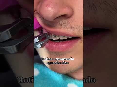 Já me viu removendo aparelho fixo? Bastidores
