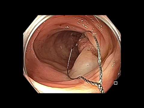 Colonoscopy: Transverse Colon Inflammatory Polyp