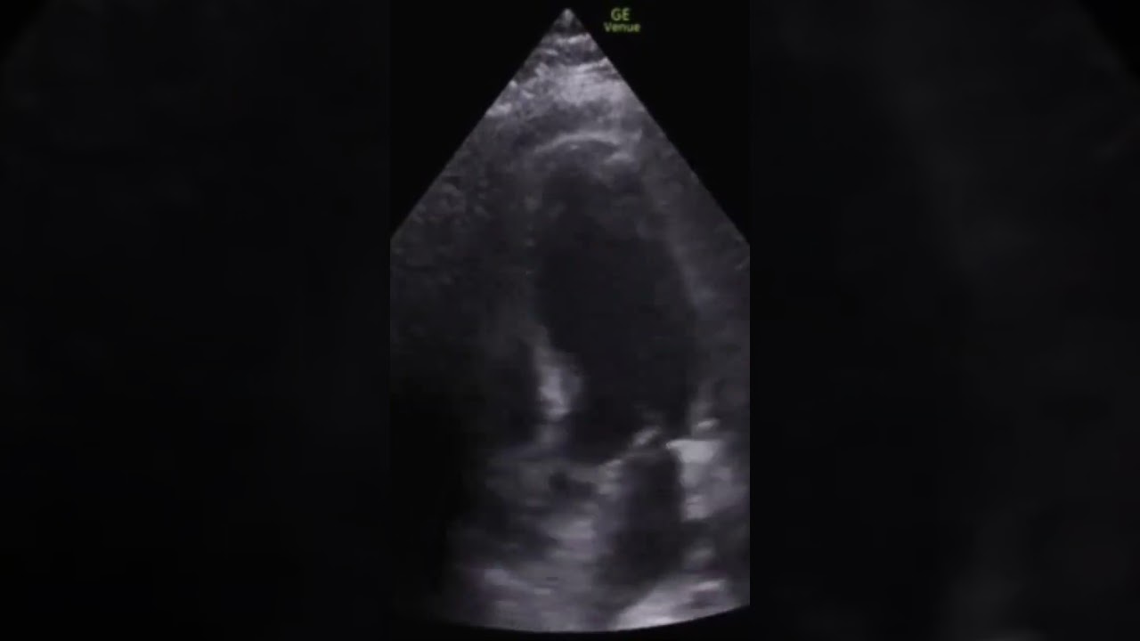 Regional Wall Motion Abnormality. Mid-distal septum hypokinesis. LAD ischemia.