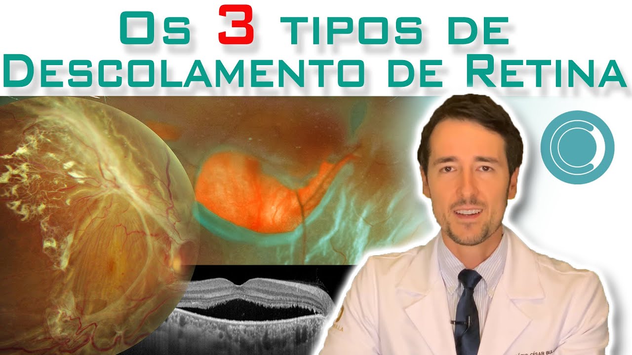 Os 3 tipos de descolamento de retina - sintomas e tratamento