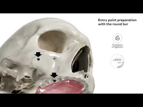 NobelZygoma™ TiUltra™ – Surgical Animation