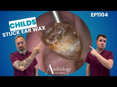 REMOVING A CHILDS STUCK EAR WAX - EP1104