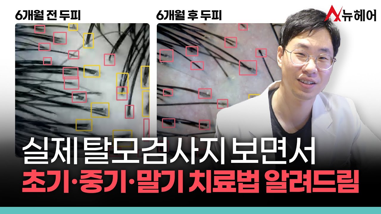 실제로 병원에서 하는 탈모검사 보여드립니다ㅣ뉴헤어
