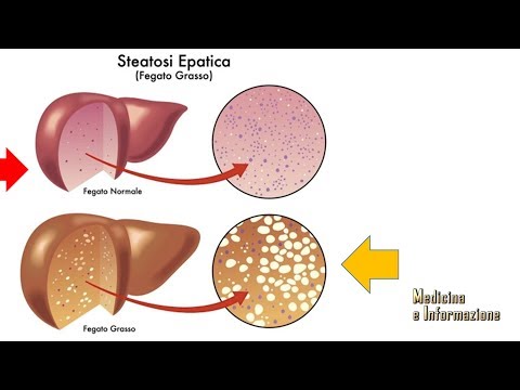 Steatosi Epatica (fegato grasso): come si previene, come si combatte