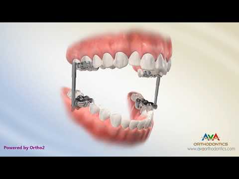 Orthodontic Treatment for Overjet (Overbite) - AdvanceSync Appliance