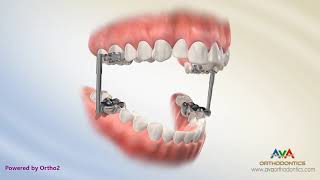 Orthodontic Treatment for Overjet (Overbite) - AdvanceSync Appliance
