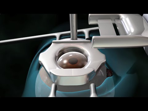 Lehetséges-e a látás helyreállítása glaukóma esetén