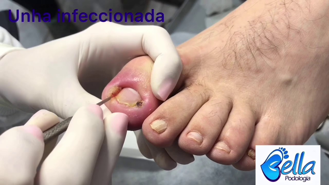 Resultado de unha encravada