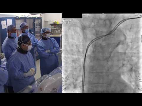 Bilateral Calcific Aorto-Iliac Disease
