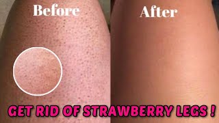 HOW TO GET RID OF STRAWBERRY LEGS IN ONE DAY! |  get rid of Keratosis Pilaris and dark spots on legs