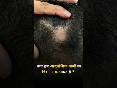 Can we prevent genetic Hair Fall ? #hairfall #hairfallsolution #hairlosstreatment