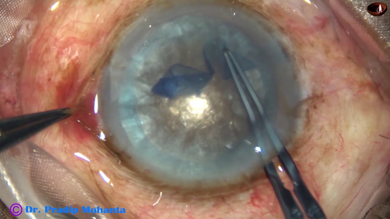 White Cataracts : Pradip Mohanta, 6th November, 2019