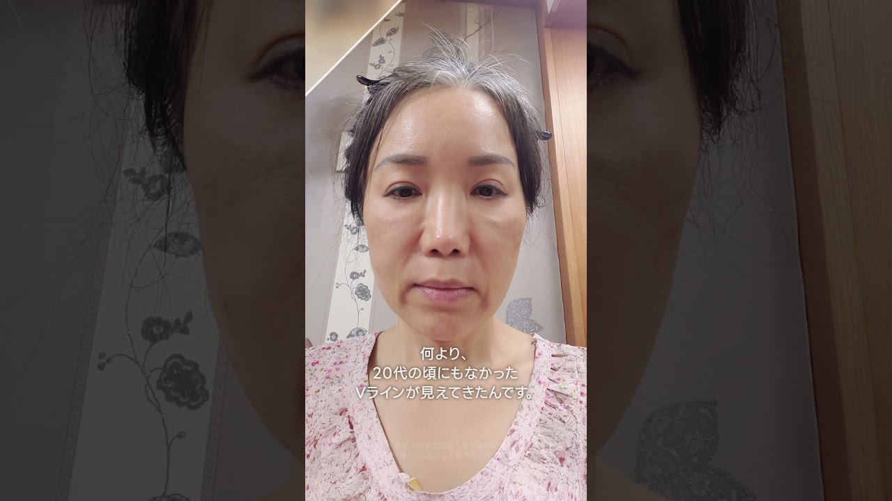 50代女性切開リフト手術リアルレビュー