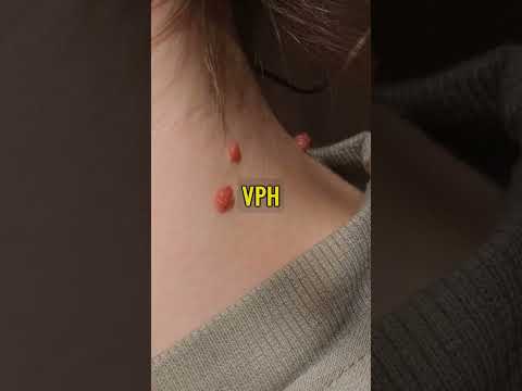 👀 ¿Qué son y porqué APARECEN las VERRUGAS? #verrugas #papiloma #piel