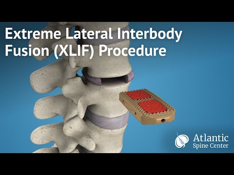 XLIF Procedure Overview