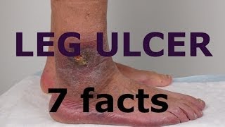 Leg Ulcers 7 Facts About Leg Ulcers You Must Know