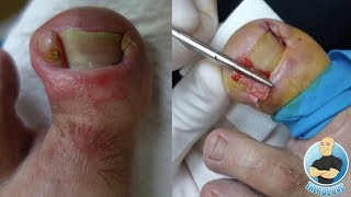 EXTREME INFECTED INGROWN TOENAIL REMOVAL OF DEFORMED TOENAIL SURGERY