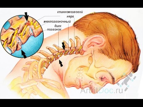 Вытягивать шею при остеохондрозе Ушиб растяжение голеностопного сустава мкб