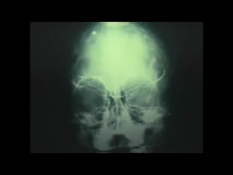 Abductions - Medical Evidence Budd Hopkins