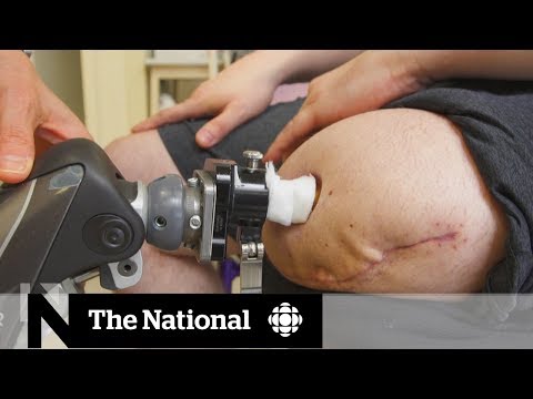 How a new surgical procedure is helping some amputees walk without pain