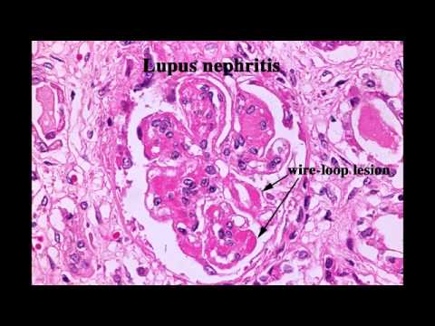 Fatty Liver, end stage renal disease, acute pyelonephritis, CLL, Lupus nephropathy & Xanthochromia