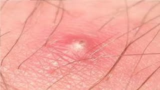 how to get rid of an ingrown hair cyst easy