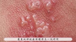 帶狀疱疹精準治療│謝昀叡醫師