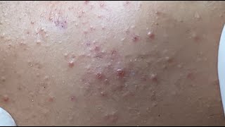 Teenager Acne Treatment P.2 #HoangMySpa193