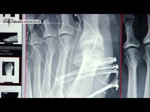 Hallux Rigidus Operation