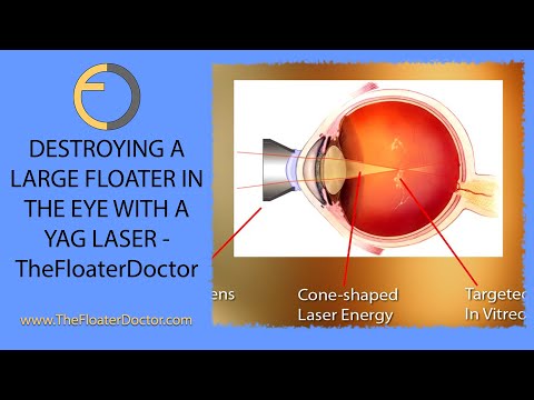 TOLD YOUR EYE FLOATERS WERE NOT TREATABLE? Watch this as absolute proof they can be by MD Specialist