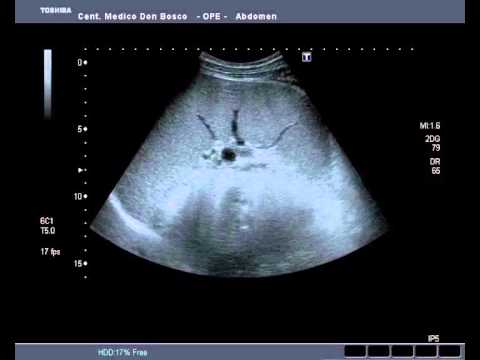Splenomegalia in EBV