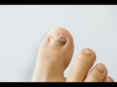 Fucorcin împotriva ciupercii unghiilor de la picioare