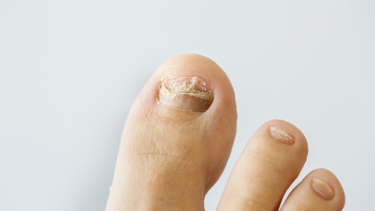 Nail Fungus Be Gone: A Step-by-Step Guide to Prevention and Treatment, Beauty Vigour