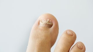 How to prevent and treat nail fungus