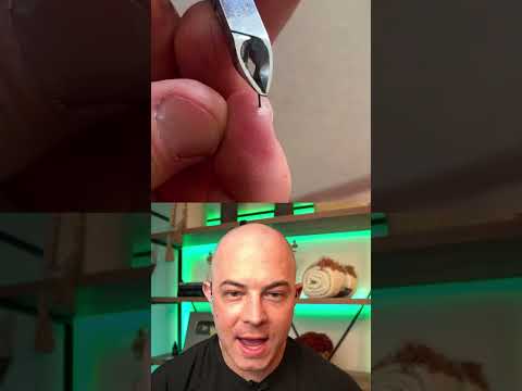 Dermatologist reacts to successful splinter removal #dermreacciona #doctorreacciona #satisfactory