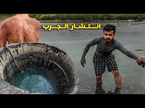 سبحت بالكبريت جسمي احترق جولة 24 ساعة الموصل