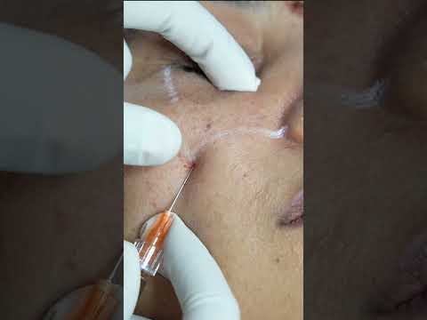 Dermal Fillers Explained | Face Fillers for Youthful Look |  Explains | Cosmo Radiance Hyderabad