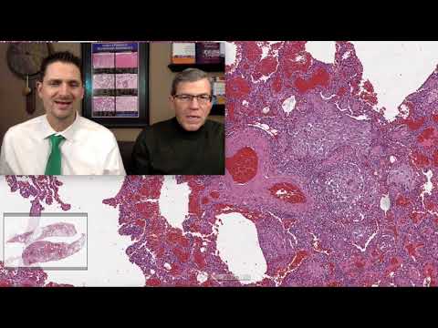 Pattern 4 – Alveolar Filling, Aspiration Lung Injury (Top 25 Pearls Series, Topic 6, Pearl 5)