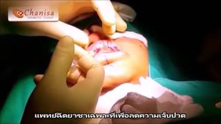 เลาะซิลิโคนเหลวบริเวณริมฝีปากบนและล่าง