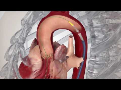 Edwards SAPIEN 3 TAVR (Transfemoral Implant Procedure Animation)