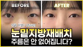 눈밑지방재배치, 수술로도 안되는 2가…