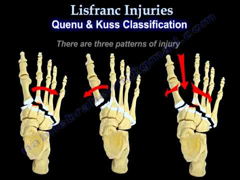 Lisfranc Injury (Tarsometatarsal fracture-dislocation) - Foot ... Lisfranc Injury (Tarsometatarsal fracture-dislocation) - Foot ...