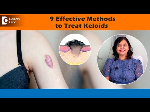 9 Methods to treat KELOIDS | Can KELOIDS be cured permanently?- Dr. Amee Daxini | Doctors' Circle