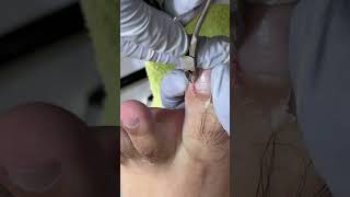 Ep_8794 Ingrown toenail removal 👣 ถ้าไม่ทำแผลจะเป็นอะไรครับ 😅 (clip from Thailand)